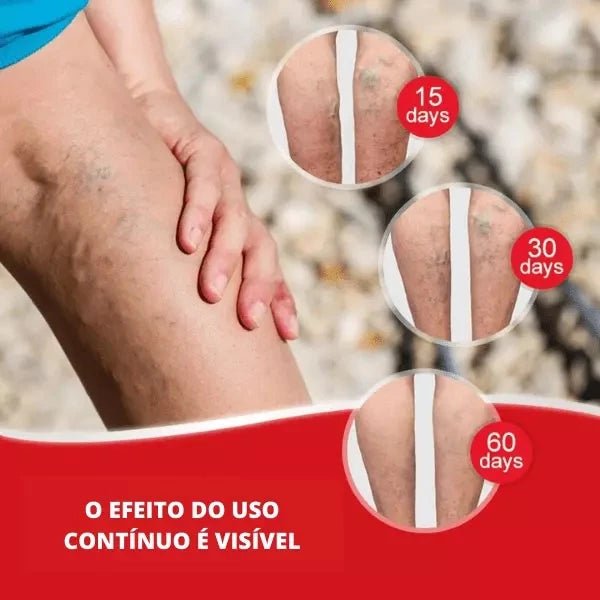 Kit Adesivos Auxilia As Varizes, Vasos E Veias Diminuição - mimarte